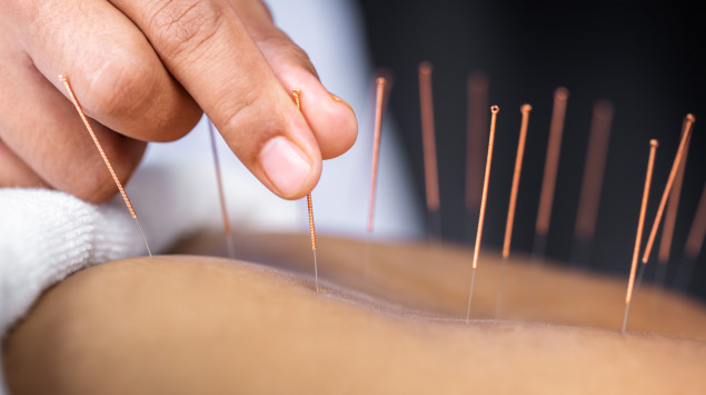 Man sieht eine*n Patient*in, an dem*der eine Akupunktur durchgeführt wird.