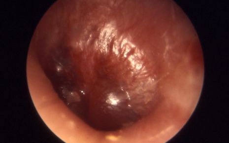 Das Bild zeigt die Aufnahme einer Mittelohrentzündung durch ein Otoskop.