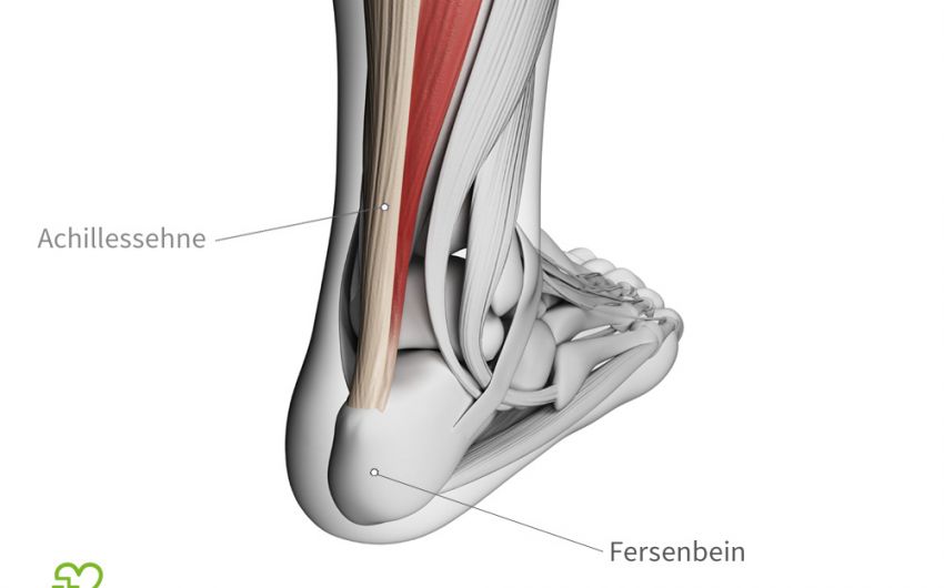Eine grafische Darstellung der Achillessehne. Bei einer Achillodynie treten die Schmerzen meist zwei bis sechs Zentimeter oberhalb des Fersenbeins auf.