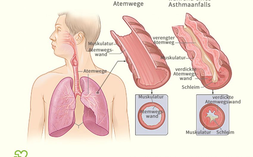 Eine grafische Darstellung der Atemwege bei Asthma bronchiale.