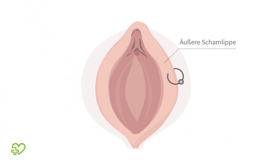 Grafische Darstellung: Intimpiercing an der äußeren Schamlippe