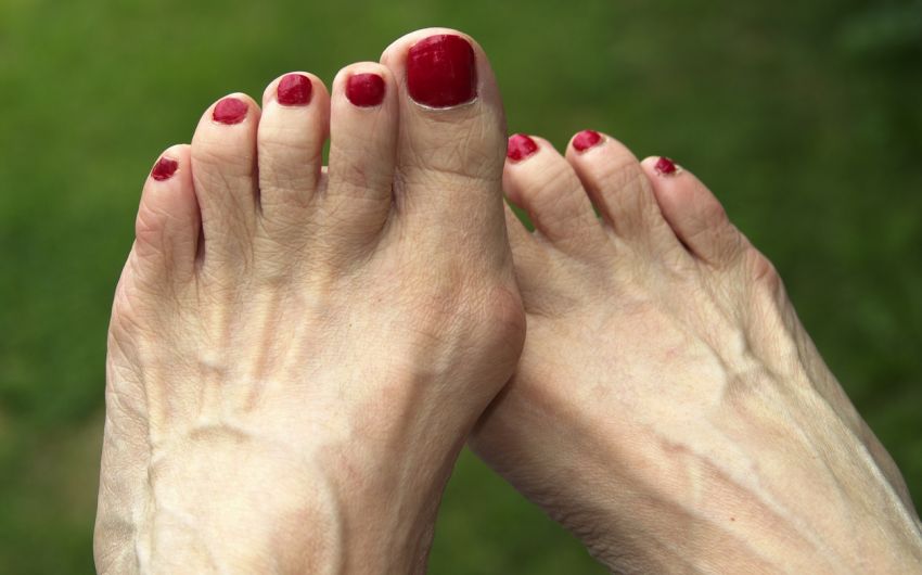 Füße mit Ballenzehen (Hallux valgus)