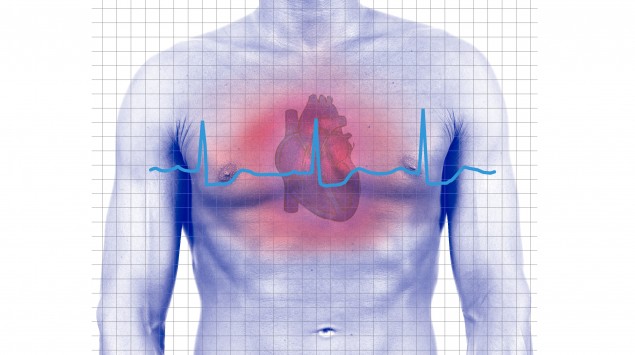 Herzinfarkt Myokardinfarkt Symptome Ursachen And Vorbeugen Onmedade 9052