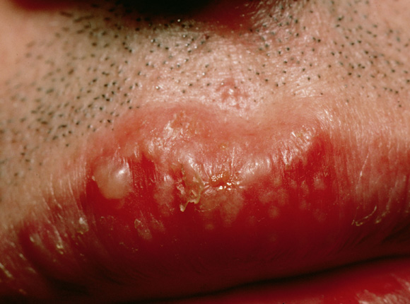 48+ Herpes im mund bilder , Bildergalerie Lippenherpes Onmeda.de