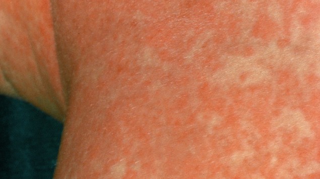 Hautausschlag Ursachen Behandlung Bilder Onmeda De 