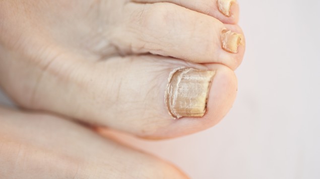 Nagelpilz erkennen und behandeln - Onmeda.de