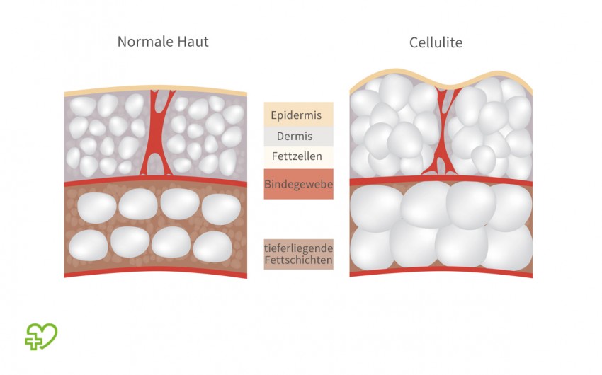 Cellulite (Orangenhaut) - Onmeda.de