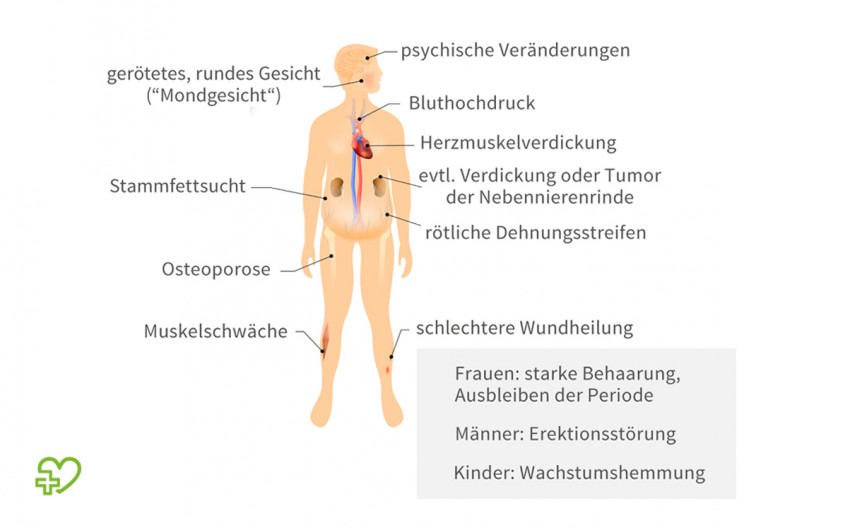 Eine Illustration zu den typischen Symptomen für das Cushing-Syndrom.