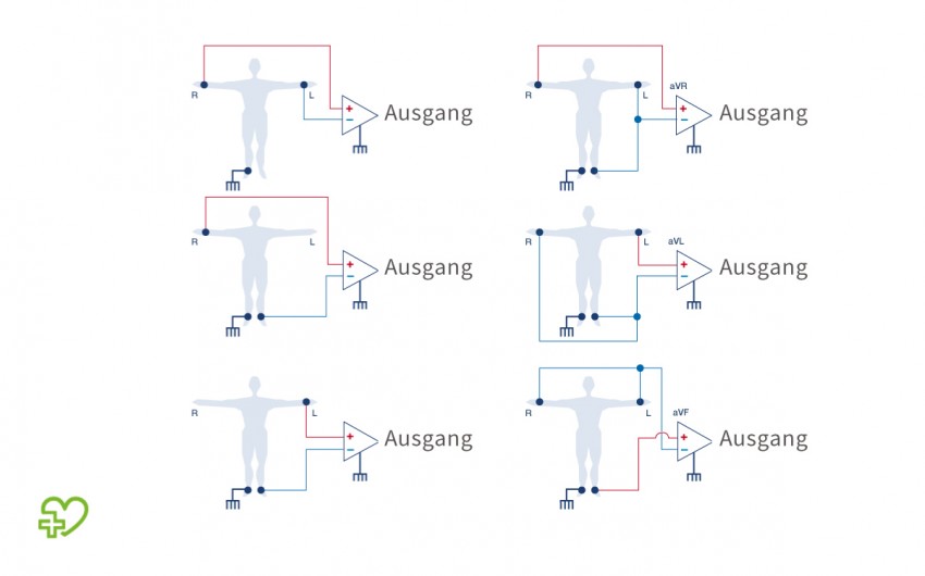 Die drei Ableitungen nach Einthoven (links) und nach Goldberger (rechts).