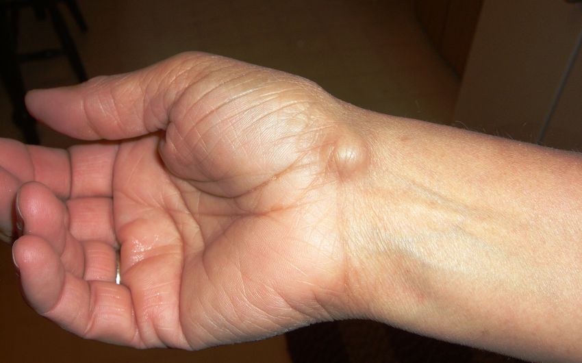 Knubbel finger Dupuytren Behandlung