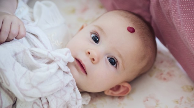 Ein Baby mit einem Hämangiom auf der Stirn