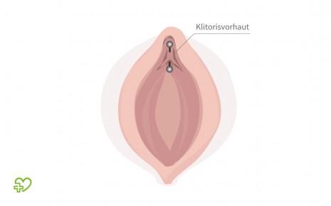 Grafische Darstellung: Horizontales Intimpiercing an der Klitorisvorhaut