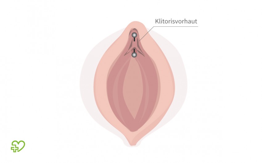 Grafische Darstellung: Horizontales Intimpiercing an der Klitorisvorhaut