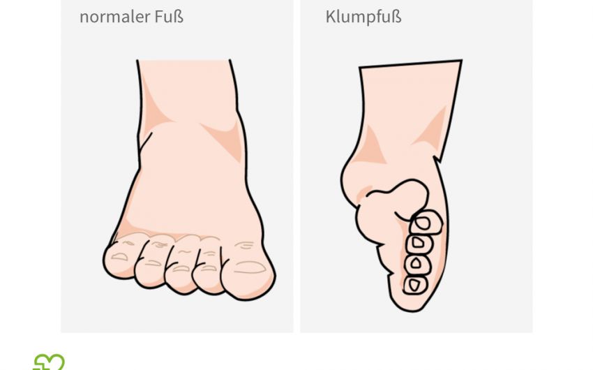 Klumpfuß: Ursachen, Symptome, Therapie bei Neugeborenen - Onmeda.de