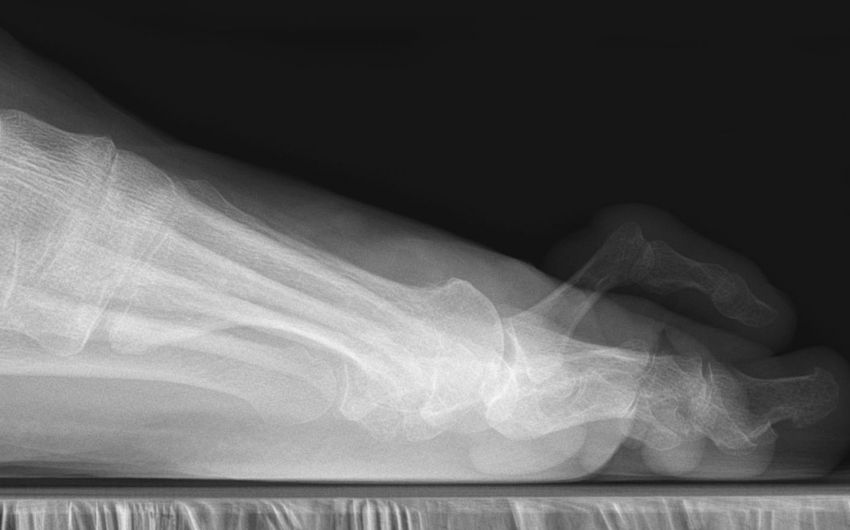 Das Bild zeigt eine Röntgenaufnahme eines Krallenzehs.