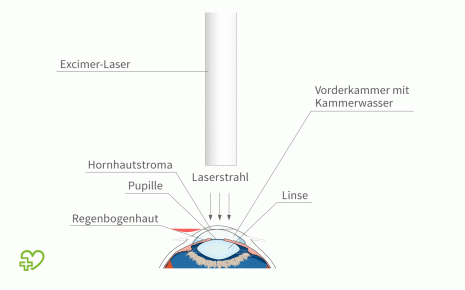 Darstellung des Lasik-Vorgangs