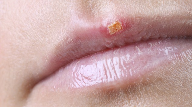 Herpes küssen trotz Lippenherpes: Vom