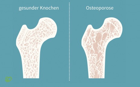 Vitamin D und Calcium zur Osteoporose-Prophylaxe sinnlos? - Onmeda.de