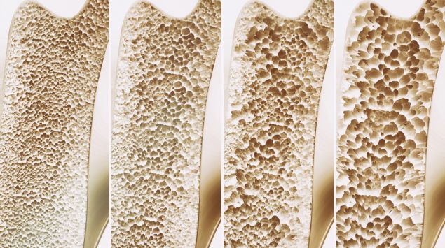 Vitamin D Und Calcium Bei Osteoporose www.onmeda.de