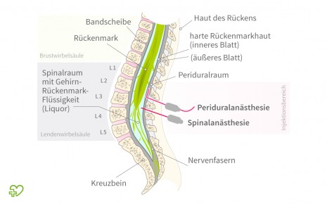 Anatomische Illustration über die Peridural- und Spinalanästhesie