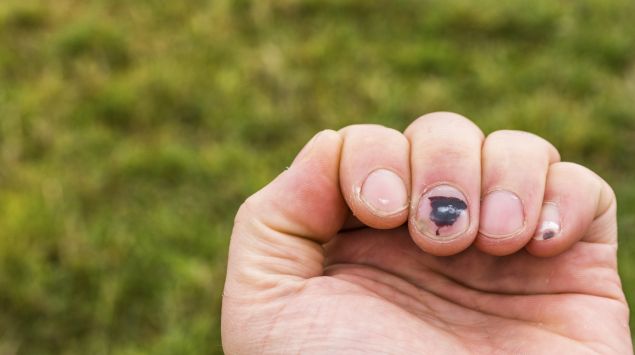 Finger geklemmt nagel blau