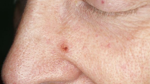 Basaliom Symptome Ursachen Behandlung Onmeda de