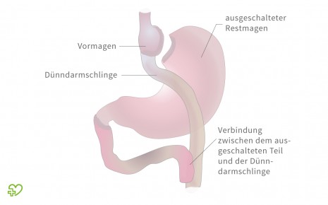 Illustration: Magenbypass