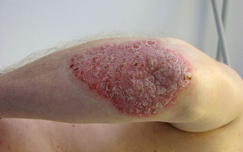 Eine Person mit Schuppenflechte am Arm.