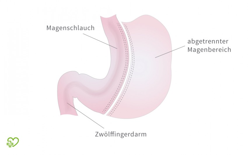 Schlauchmagen