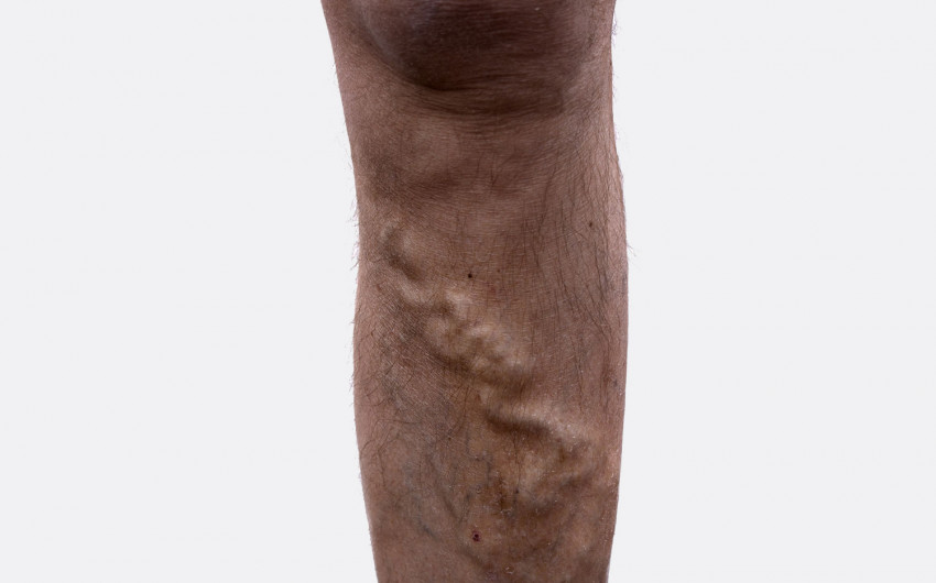 Man sieht ein Bein mit Krampfadern im fortgeschrittenen Stadium (Varikose).