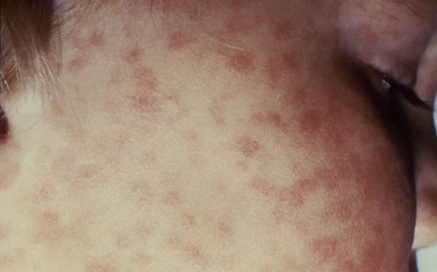 Wenige Tage nach seinem Ausbruch verursacht das Zeckenbissfieber durch Rickettsia rickettsii meist einen massiven Hautausschlag (Exanthem): Es entstehen kleine, rote Flecken mit erhabenen Papeln, teils auch kleine Einblutungen (sog. Petechien). Daher kommt auch die Bezeichnung Fleckfieber. (Bildquelle: CDC)