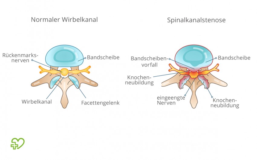 Schematische Darstellung der Ursachen einer Spinalkanalstenose