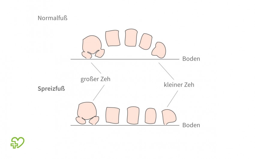 Im Vergleich: skizziertes Seitenprofil von einem gesunden Fuß und einem Spreizfuß