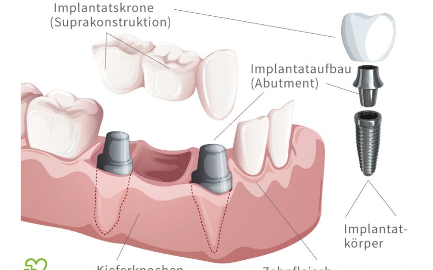 Illustration: Darstellung eines Zahnimplantats
